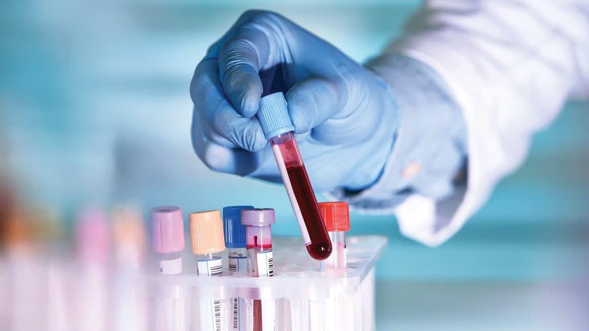 El Alzheimer ya se puede detectar por medio de una prueba de sangre 