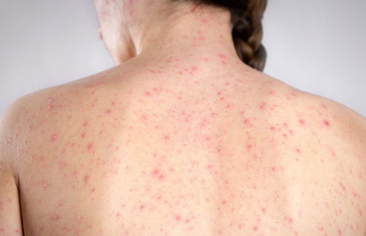 Sarampión en México: Se registra primera muerte en 2026