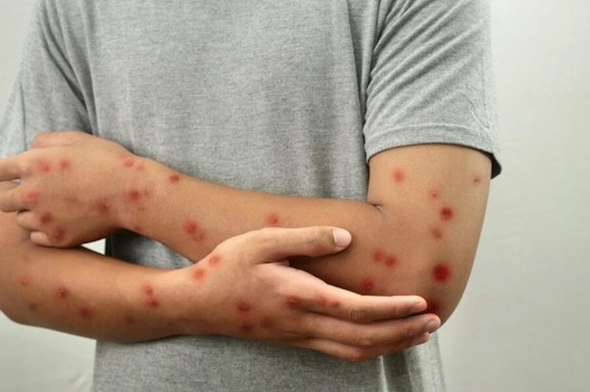 México ya tiene el primer caso de viruela símica 