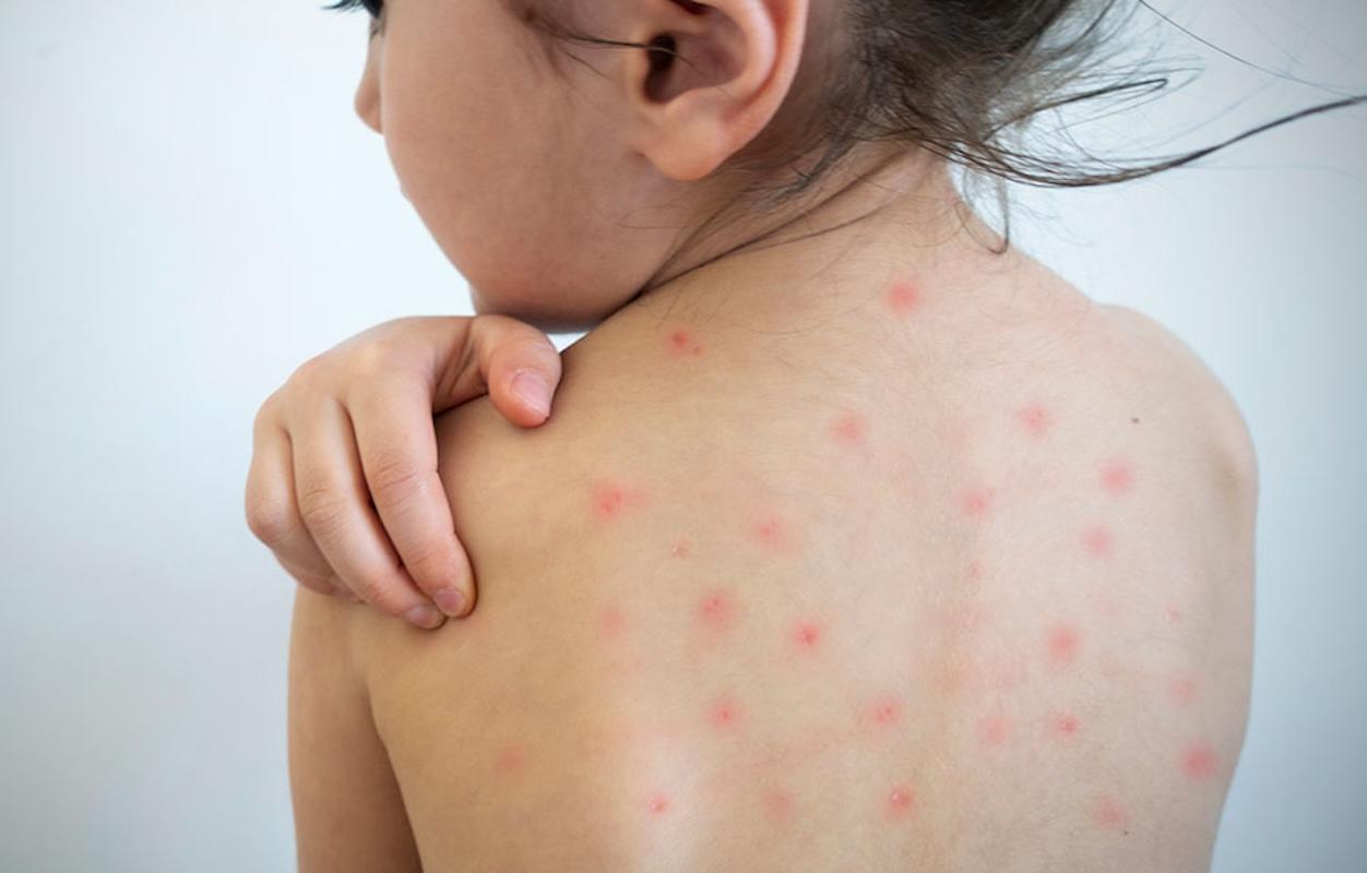 Sarampión: una amenaza que volvió a cobrar fuerza