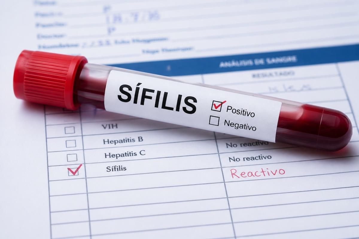 Alertan por incremento de sífilis en México; los casos se triplicaron en 10 años